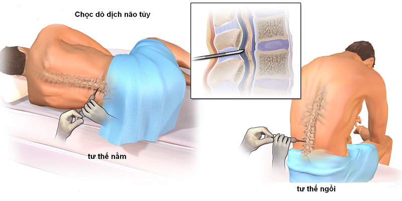 Xét nghiệm máu, dịch não tuỷ